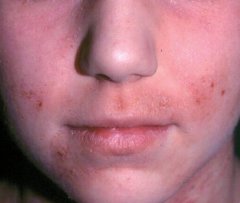 Eczema