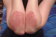 Psoriasis