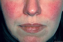 Rosacea